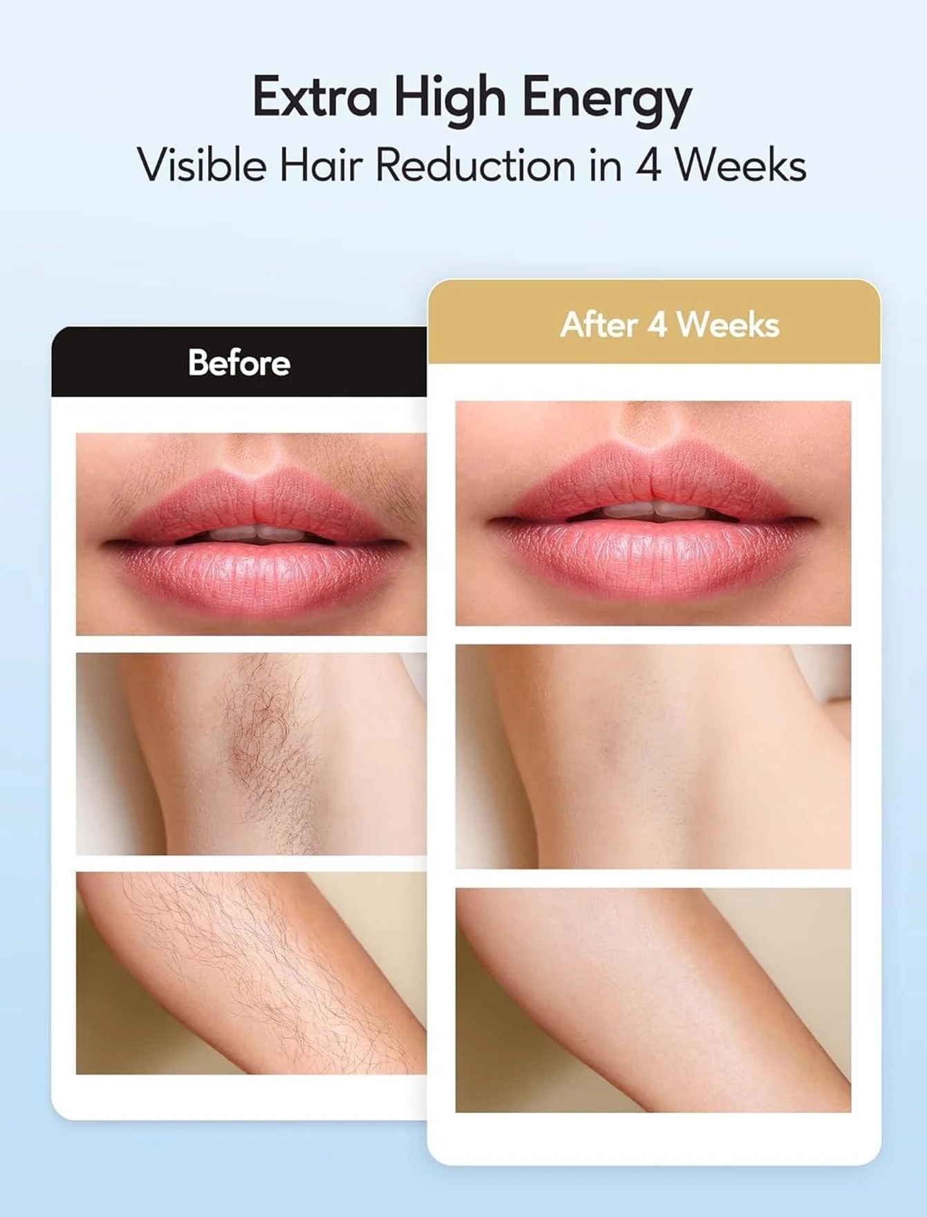 Thumbnail 4 - #36 Best IPL Devices to Buy In 2026