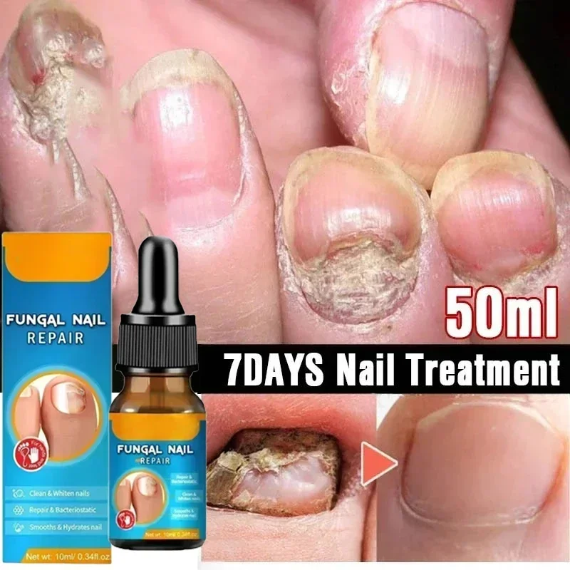 Fungal Nail Treatment Oil Foot Repair Essence Toe Nail Fungus Removal Gel Anti Infection Cream Fungal Nail Removal