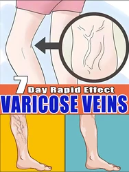 Laser varicose veins, fast repair of spider leg blood vessel dredging