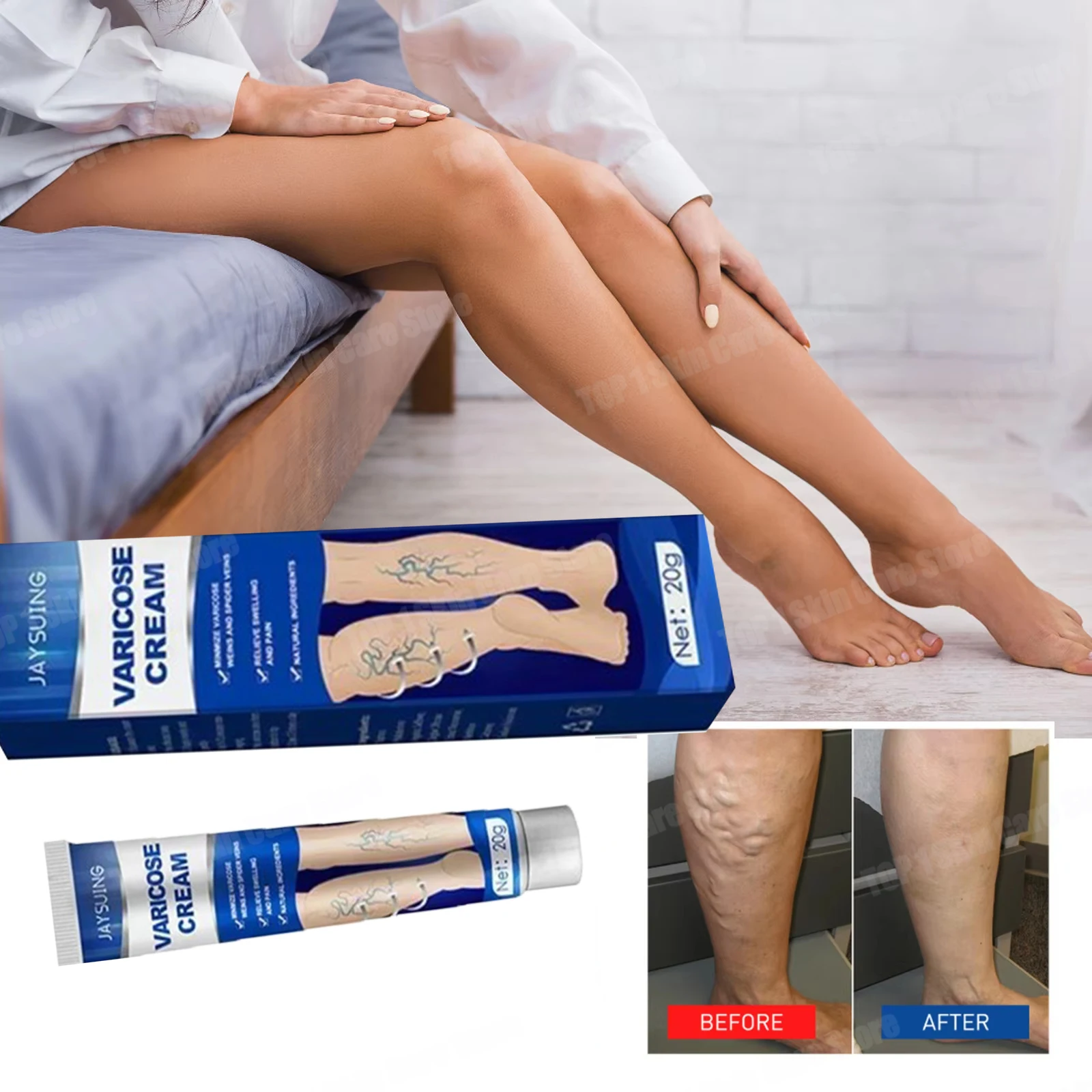 100%Original Vasculitis Blood Circulation Varicose Veins Treatment New Cream 20g