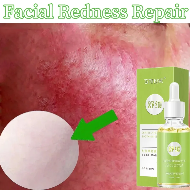 7 Day Repair Redness Serum Sooth Itching Sensitive Skin Improve Rosacea Shrink Pore Smooth Nourish Facial Skin Korean Cosmetics