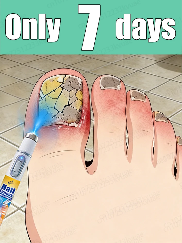 

Say goodbye to fungal infections with nail laser pen.