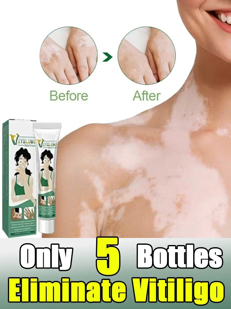 NewVitiligo Cream Natural Relief Skin Treatment Soothing White Spot Removal Vitiligo Cream Eliminate Pigment