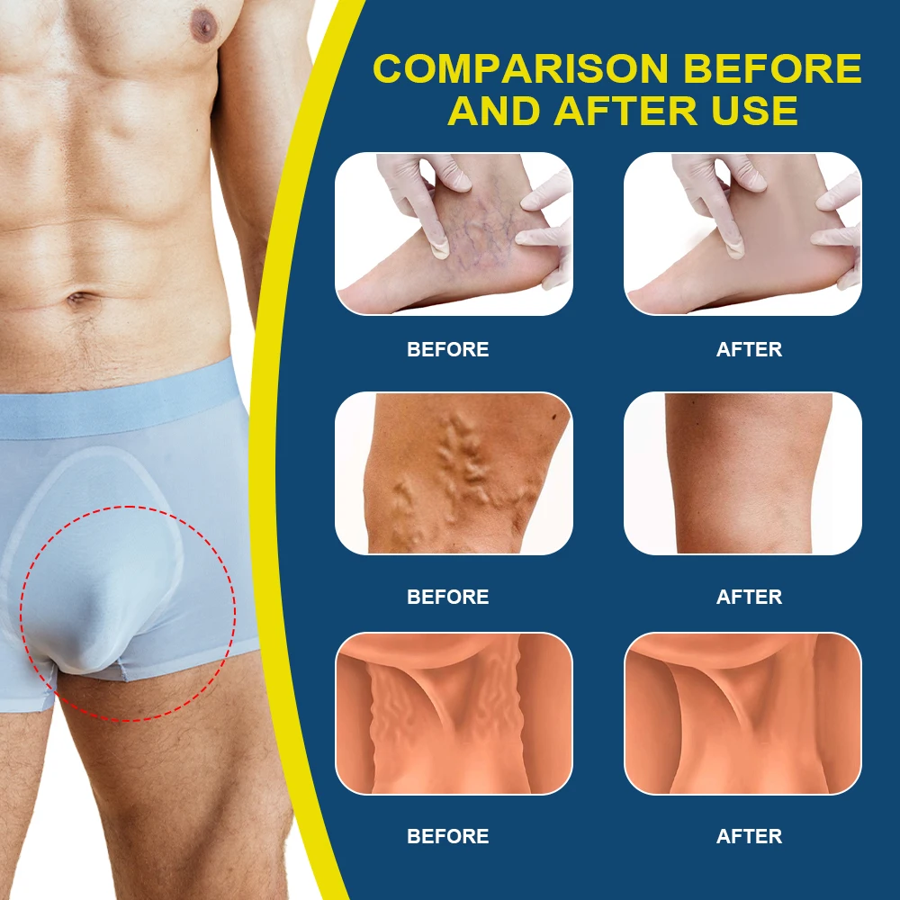 1/3/5/7/10pcs Sumifun Varicocele Varicose Vein Spray Phlebitis Vasculitis Liquid Varicosity Angiitis Cream Skin Repair Plaster