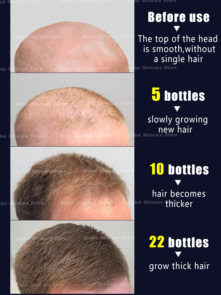 98% of buyers buy again, have more and more hair, say goodbye to baldness, thick hair,Hot selling product