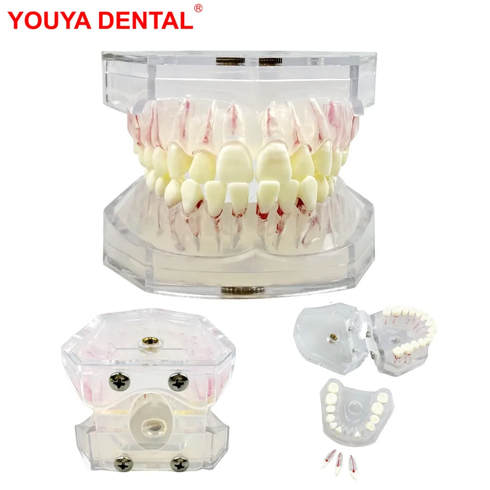 

Endodontic Teeth Model For Training Practice Tooth Extraction Model Dental Standard Model With Removable Root Canal Typodont New