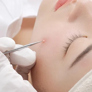 أفضل 9 محاكي ضغط حب الشباب مبيعا - رقم 10