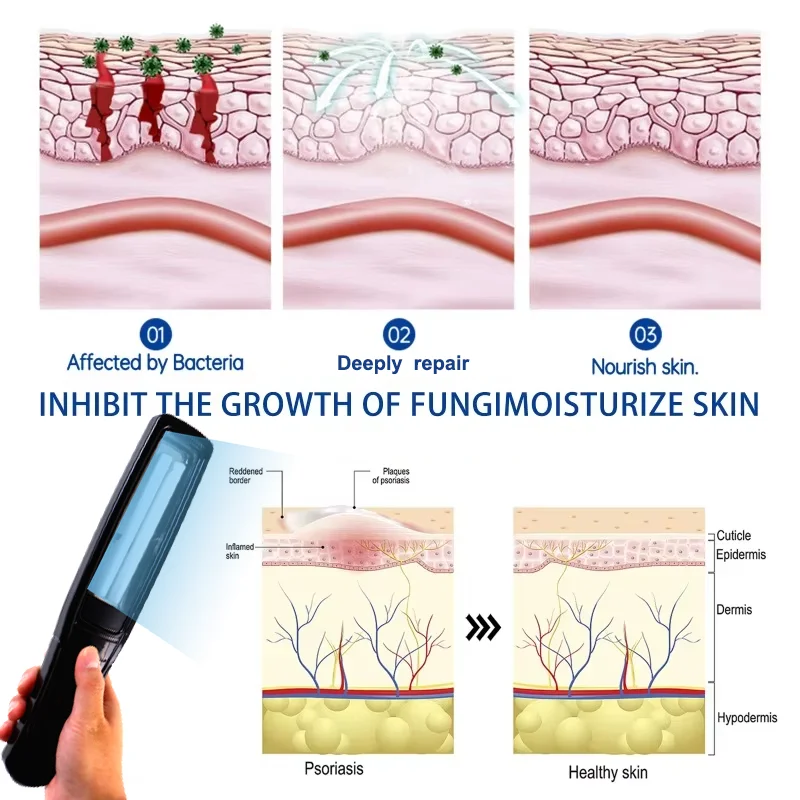 Strumento per fototerapia ultravioletta da 311 nm utilizza la lampada UVB UV per vitiligine, psoriasi, macchie bianche, malattie della pelle