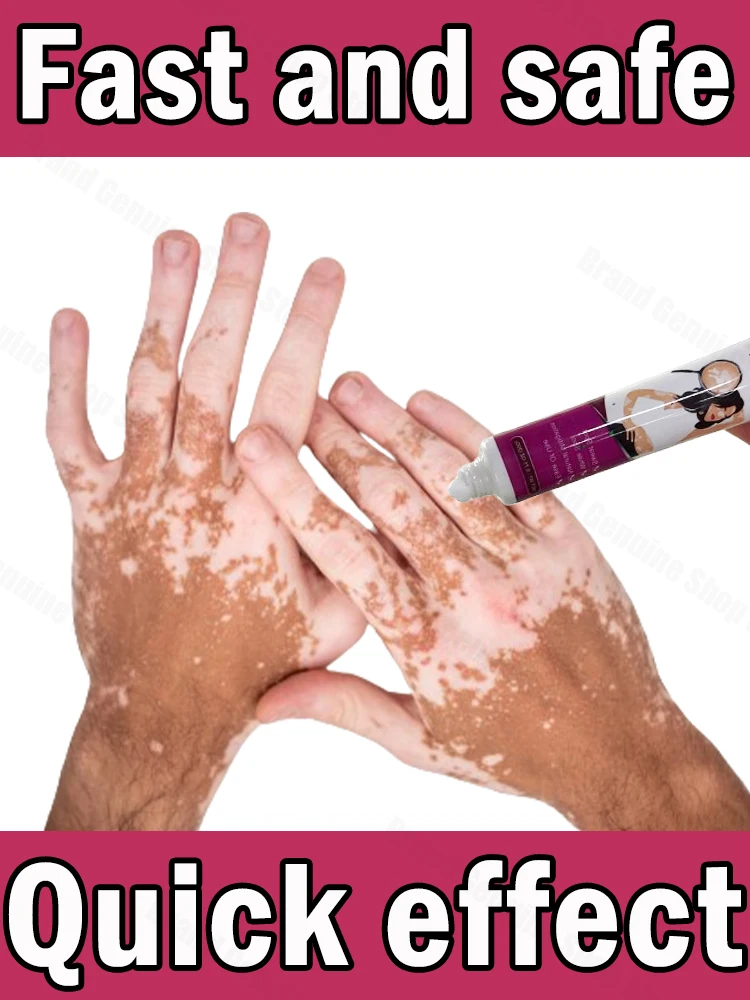 Pour l'Application Lourde Efficace du Vitiligo