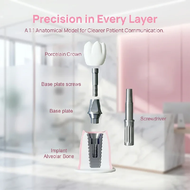 Dental Implant Model Training Teeth Teaching Practice Model Detachable Oral Implant Dentistry -Patient Communication Demo Model