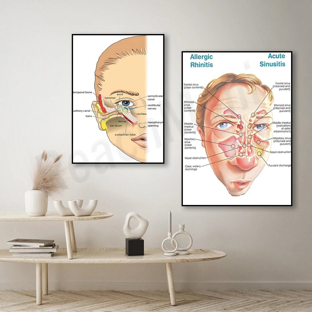 Allergic rhinitis and acute sinusitis poster, human anatomy educational chart, allergy symptoms poster, ear anatomy, medical gif