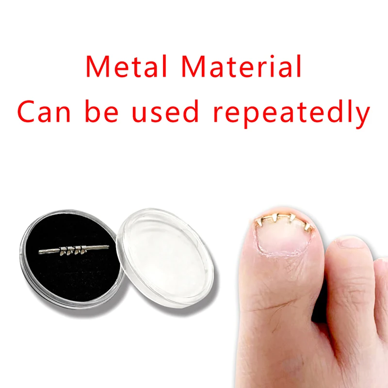 1PCS Professionelle Eingewachsene Kappe Nagel Korrektur Draht Fixer Behandlung Werkzeug Pediküre Paronychie Erholen Zehennägel Corrector Reusable