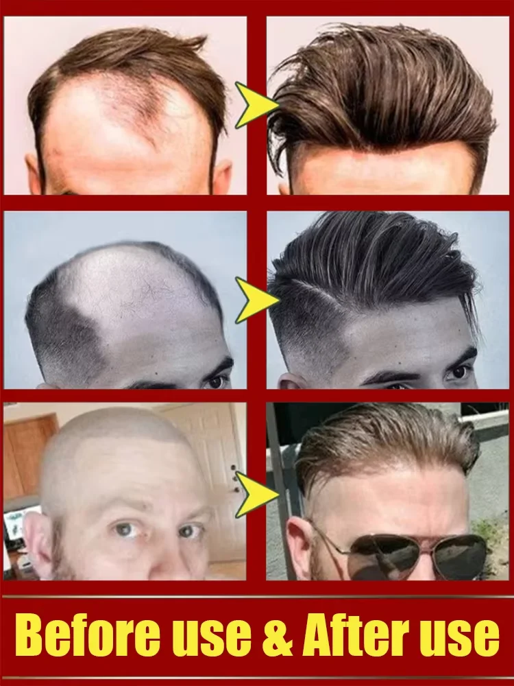 Hot sale, buyers will buy again, hair is getting more and more, say goodbye to baldness, sparse hair starts to become thick