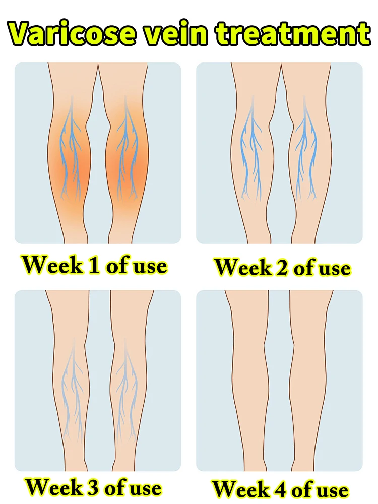 

The second generation relieves leg phlebitis and dilated vasculitis, avoiding surgical pain