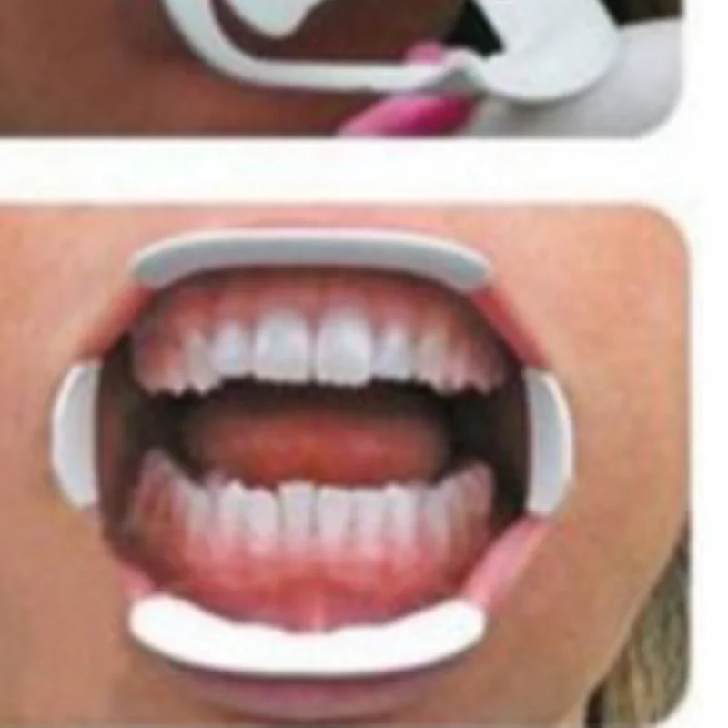 

3D стоматологический открывалка для рта, ретрактор для губ для ортодонтического осмотра полости рта, профессиональный стоматологический инструмент, стоматологический инструмент