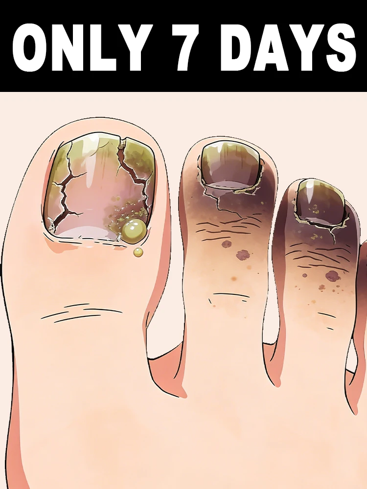 โรคเชื้อราที่เล็บ นี่คือเรื่องเล็กๆ น้อยๆ ที่ทำให้รู้สึกหงุดหงิดจริงๆ! เล็บที่ดีต่อสุขภาพสามารถเปลี่ยนสีเป็นสีเหลืองและดำได้