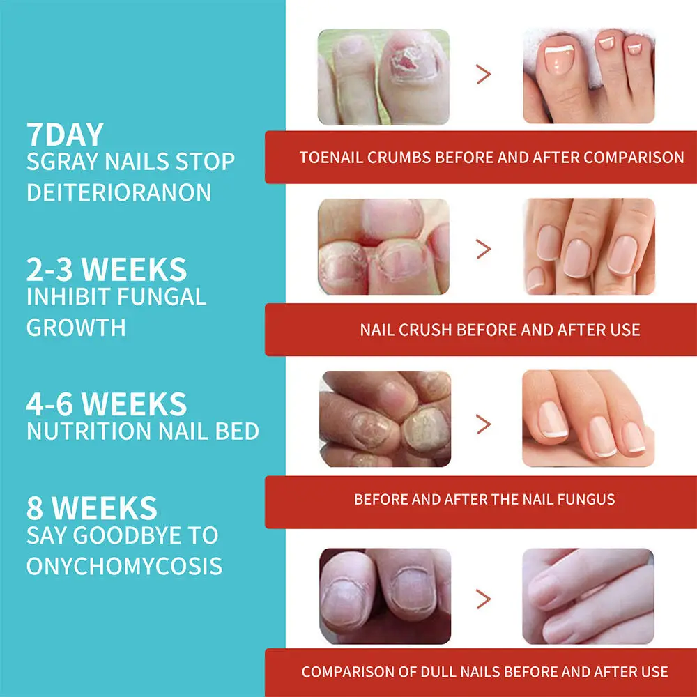 16/32 قطعة القدم مسمار تصحيح ملصق رقعة إصلاح الأظافر الفطرية سماكة لينة علاج الداحس مقاوم للماء لزجة العناية بالقدم #5