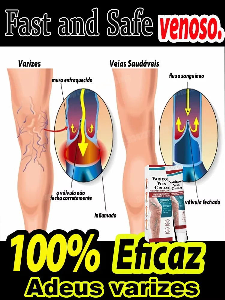 Varicose Vein Care Cream Improves Blood Circulation, Gentle Nourishing Massage Relieves Leg Discomfort and Pain 1