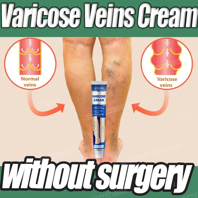 Soothing Leg Pain and Vasculitis Relief Herbal Varicose Veins Cream Foot Care Tool