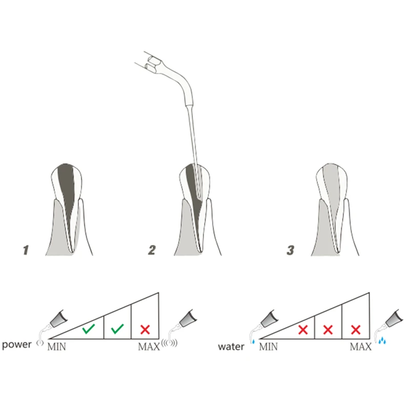 Embout Endo Dentaire ED4 pour Machine à Ultrasons, Équipement pour Enlever le Remplissage et les Matériaux Étrangers, SATELEC/DTE