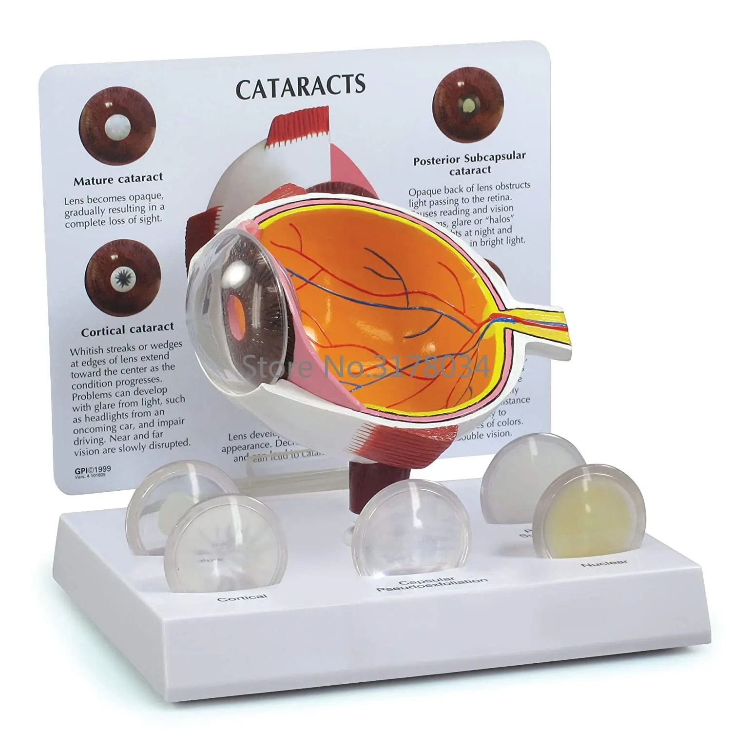 

Human Cataract Eye Anatomical Model Body Anatomy Replica of Normal Eye for Doctors Office Educational Tool