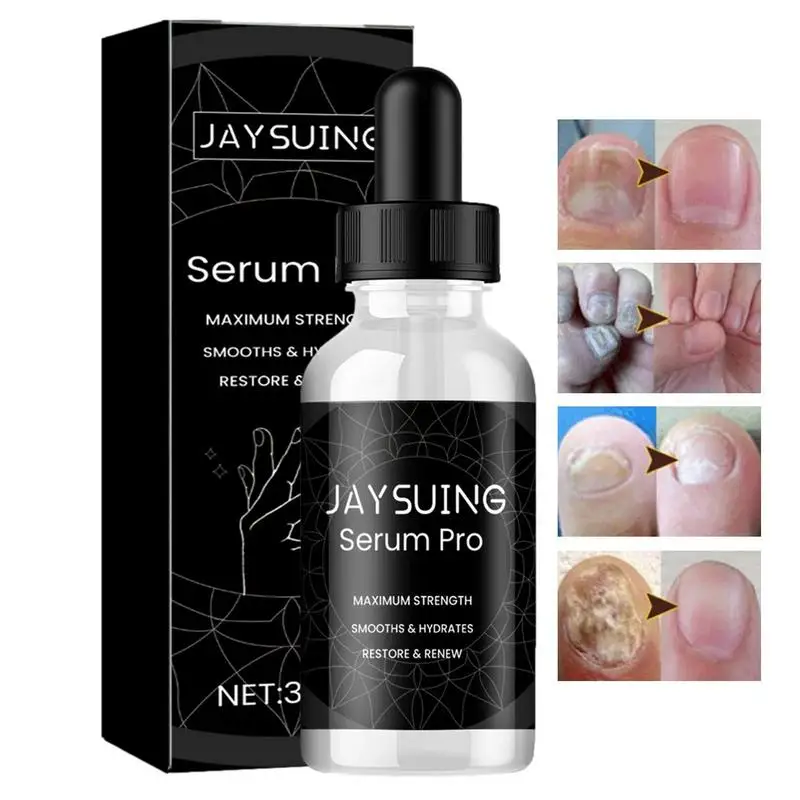 Feet Nails Repair Essence 30ml Fungi Toe Nail Solution Toe Nail Strengthener Multi Purpose Nail Renewal Essence Solution