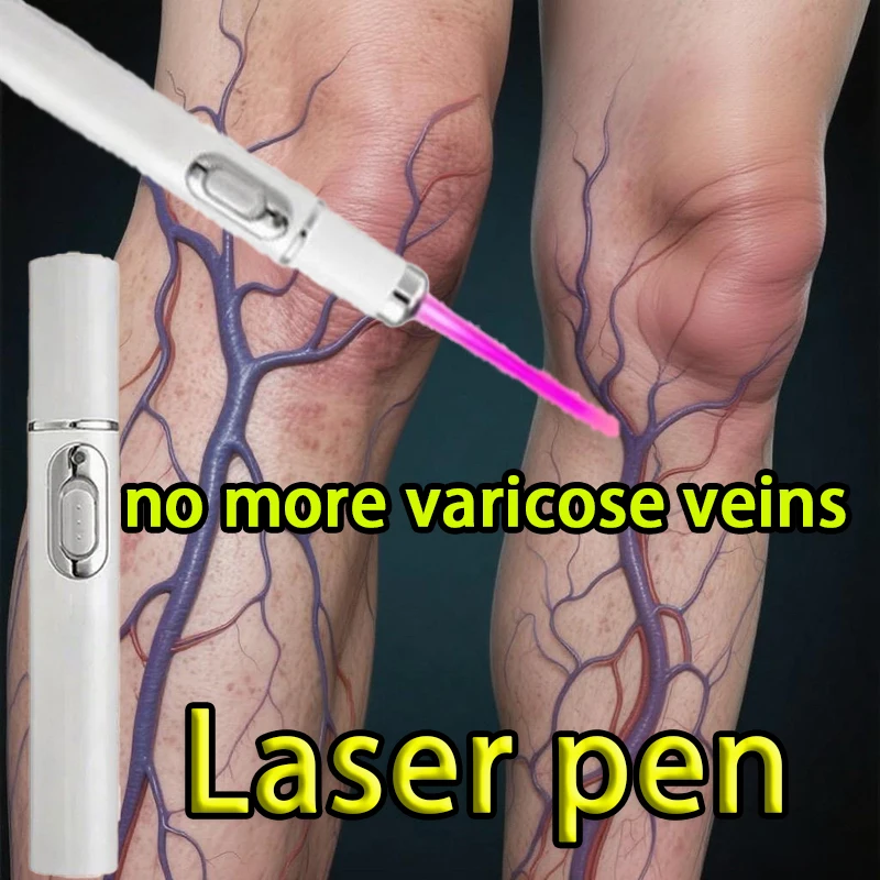 

Varicose vein laser pen,No more varicose veins.