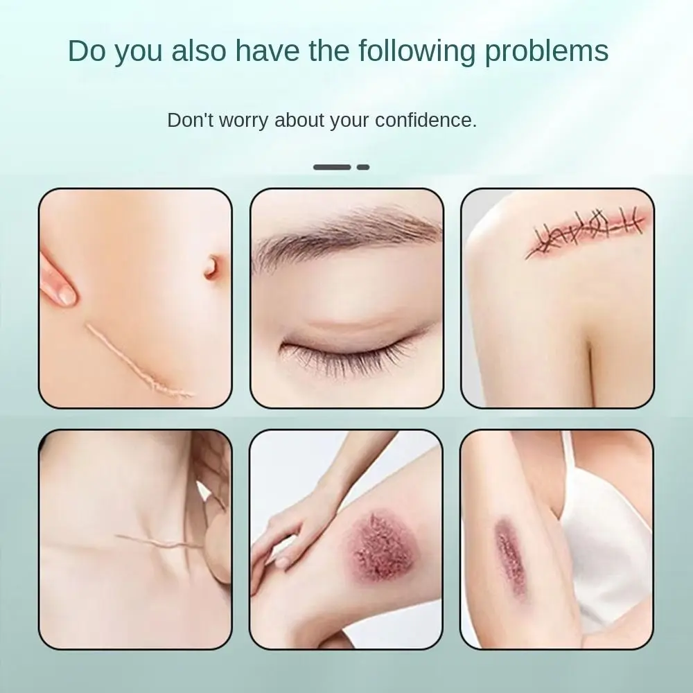 

Soft Self-Adhesive Silicone Scar Sheets Roll Reusable Easy-Tear Scar Treatment Tape Anti-UV 4*300cm Universal Skin Patches Burns