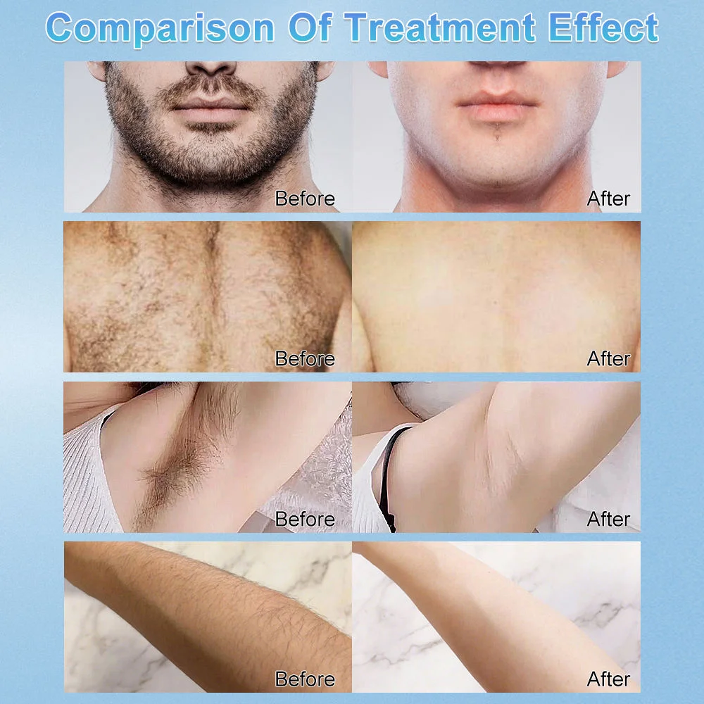 Máquina de depilación láser de diodo portátil FDAus CE 808nm indolora hielo fresco permanente para todos los tonos de piel para uso en salón en casa