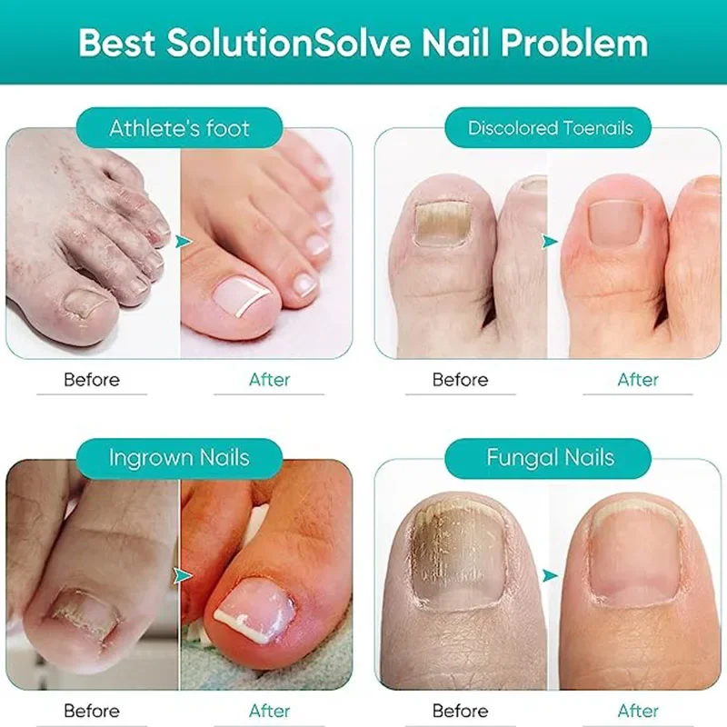 Nail Fungus Treatment Serum Toe Fungal Repair Products Hand Foot Care Removal Gel Anti Infection Paronychia