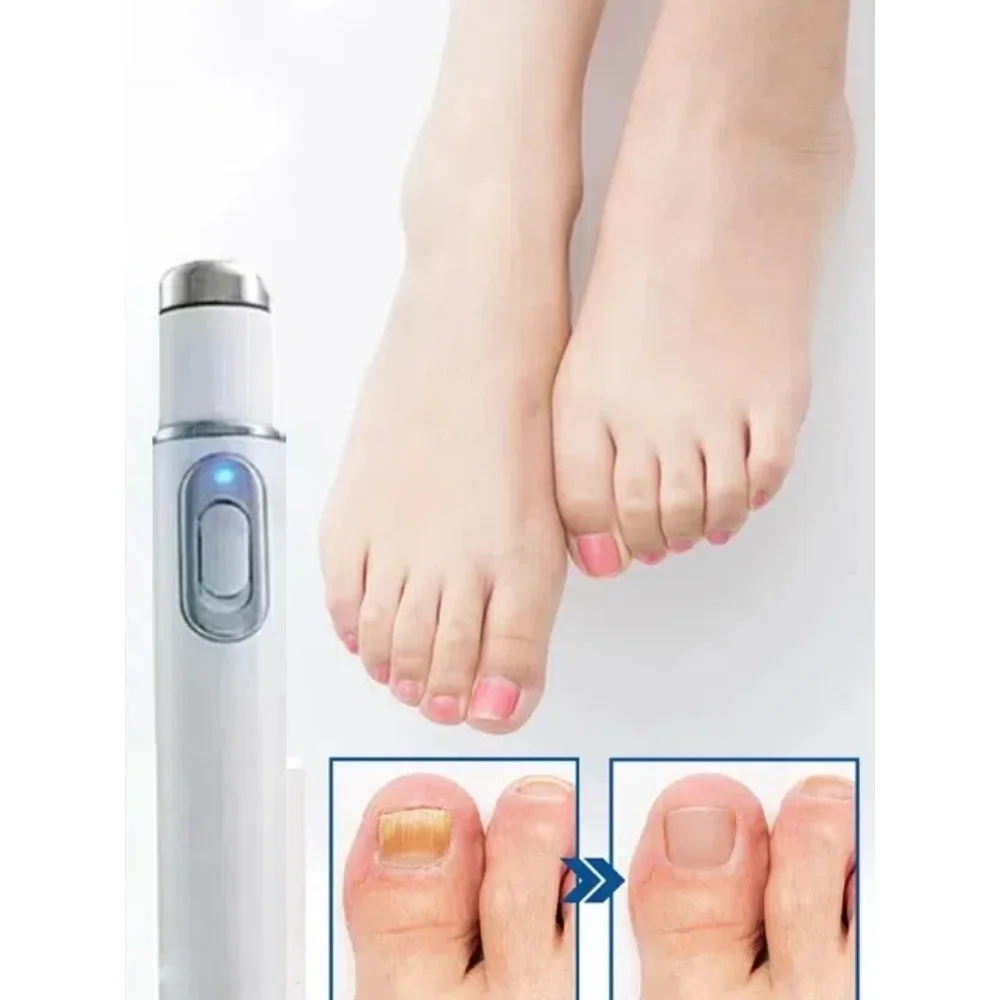 

Anti Fungal Laser Pen for Toenails - Rechargeable Nail Restoration Device, Safe Fungus Killer for Thick Discolored Nails