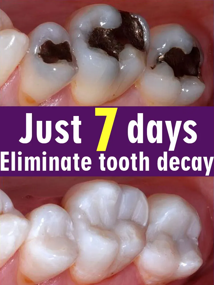 Solve tooth decay problem