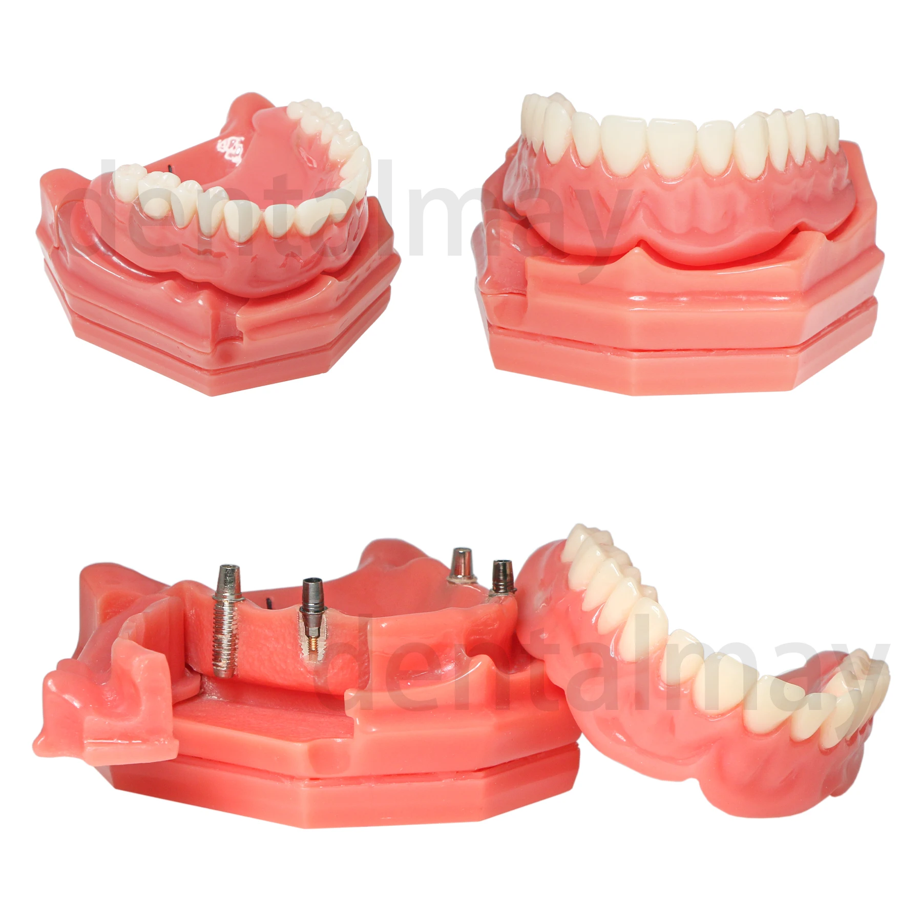 Dental Implant Teeth Model Overdenture Model Demonstration Semi-Oral Movable with Partial Denture Demo 2 Implants M6001-A