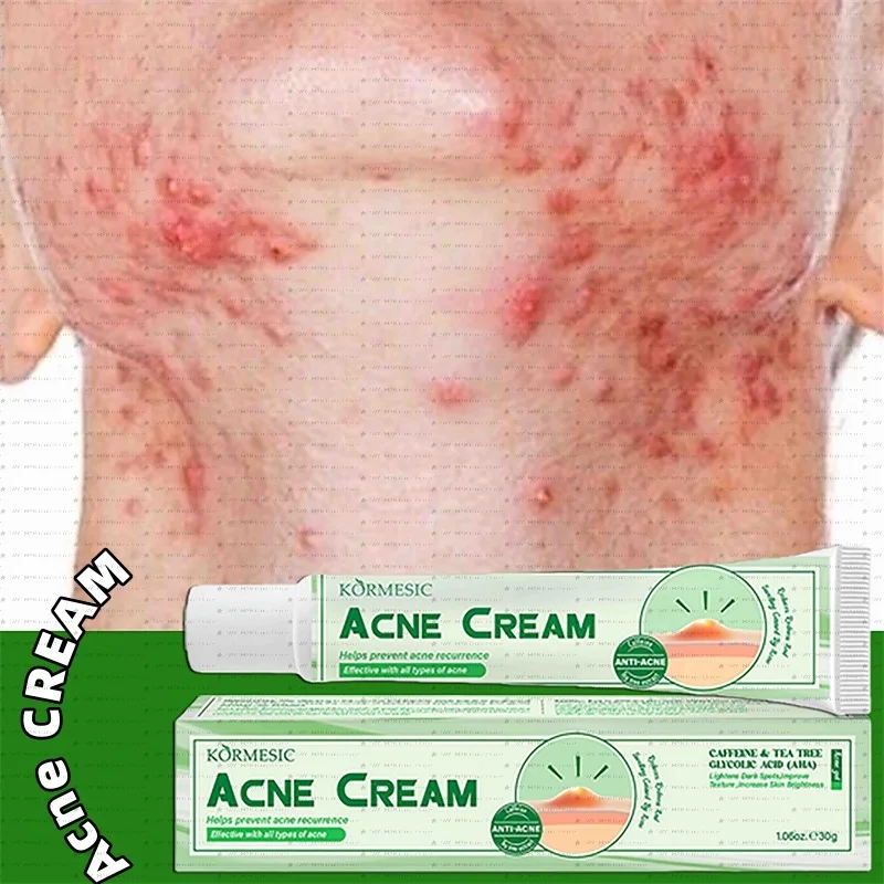 

Salicylic Acid Acne Cream Shrink Pores Blackheads Scars Acne Marks Blemishes Oil Control Whitening Korean Skin Care Cosmetics