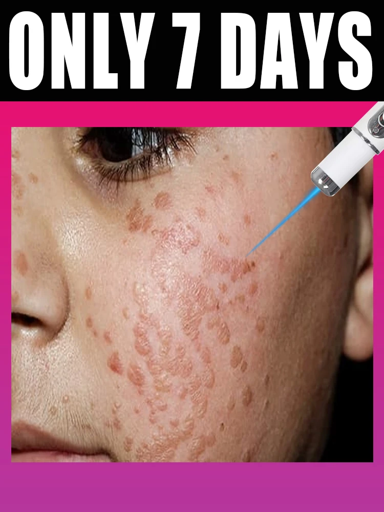 strumento per verruche per il corpo, penna a luce laser blu, trattamento per verruche per il corpo liscio