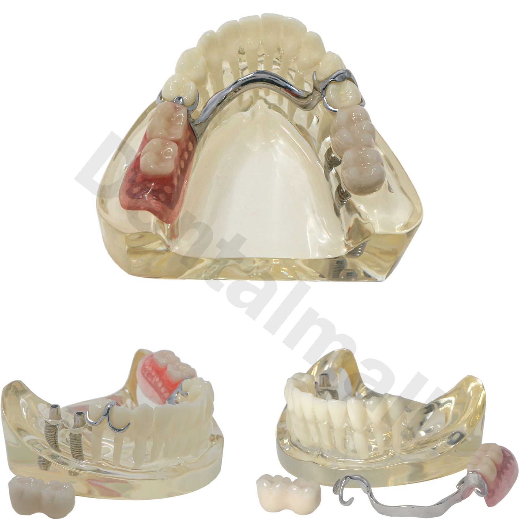 M6022 Dental Teeth Model Typodont with Partial Denture Restoration Demo 2 Implants