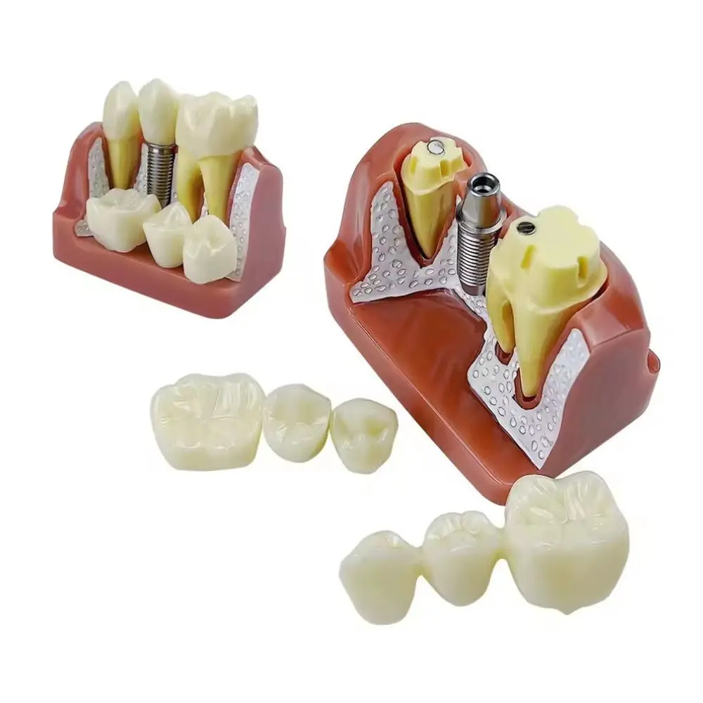 Dental Implant Demonstration Model Teeth Implant Analysis Crown Bridge Removable Model For Dentist Student Teach Study