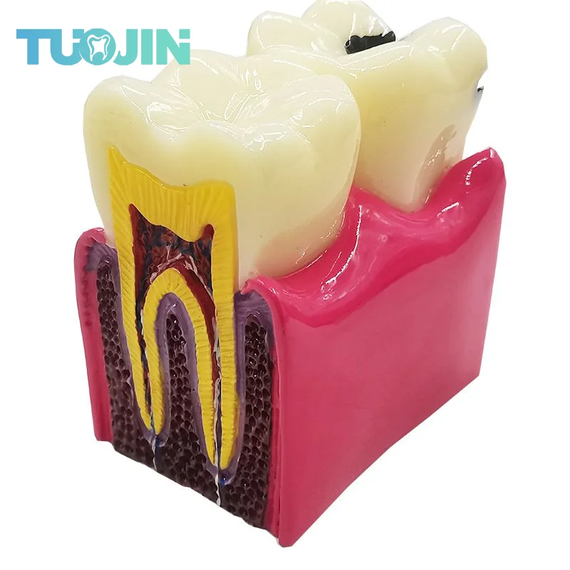 Dental Clinic Display Teaching Model Six Times Section of Caries Saprodontia Contrast Decayed Tooth Model