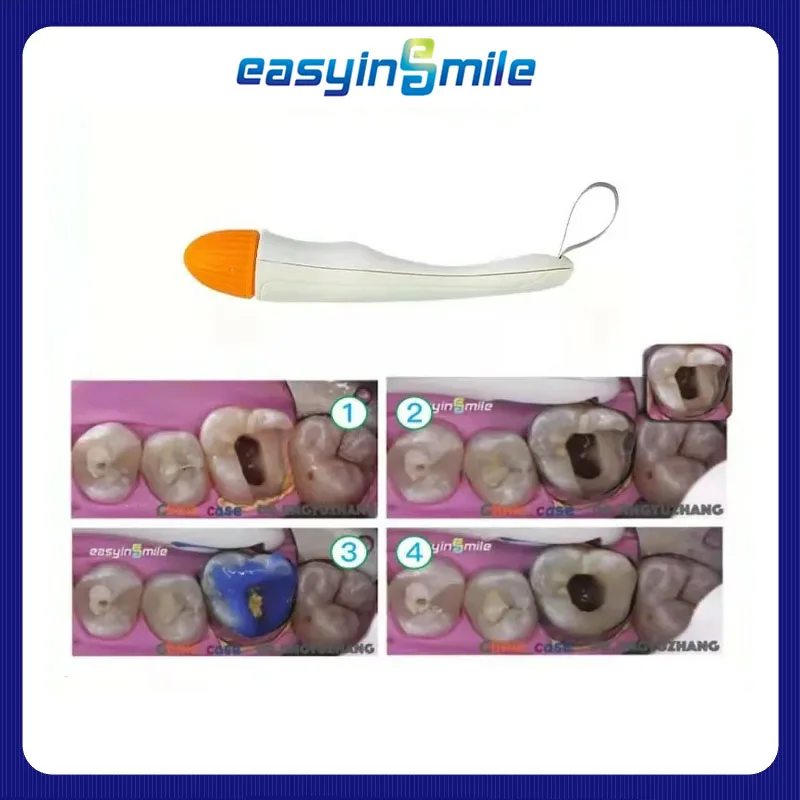 

Dental Pro Matrix Bands Molar/Premolar Matrices bands Adjust 10/50pc For Dentisty Pre FormedEasyinsmile