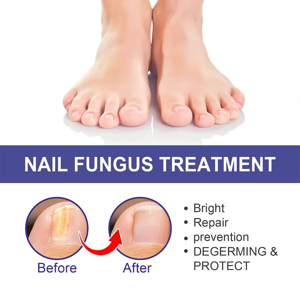 Anti Infection Onychomycosis Repair Serum, Tratamento Fungoso do prego, Essência do cuidado dos pés, Toe Fungal Removal, 10Pcs