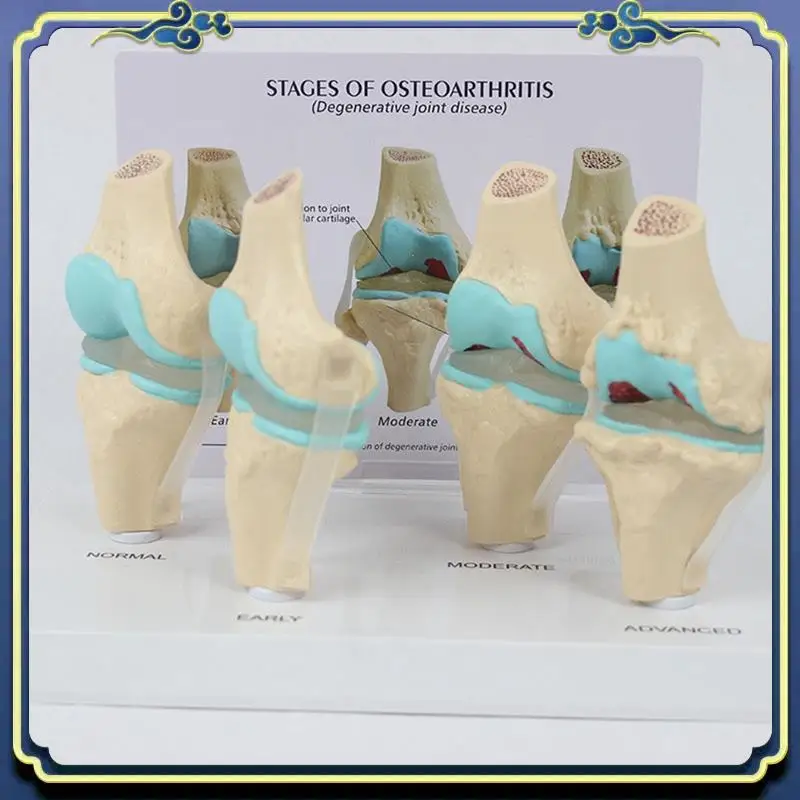 Portable Knee Kit Osteoarthritis Anatomy Model With Educational Key Card 4 Stage Knee Model Orthopedic Teaching Aids