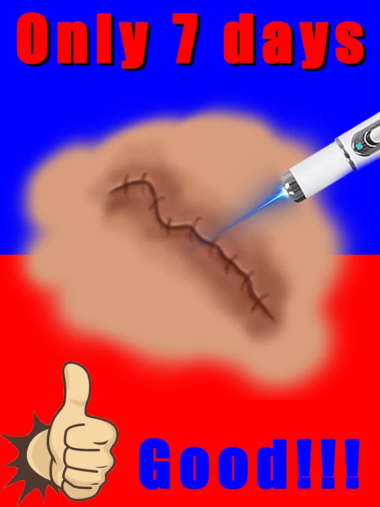 

[2025 hotsale]blue light pen solve scar,free shipping,scar care tools