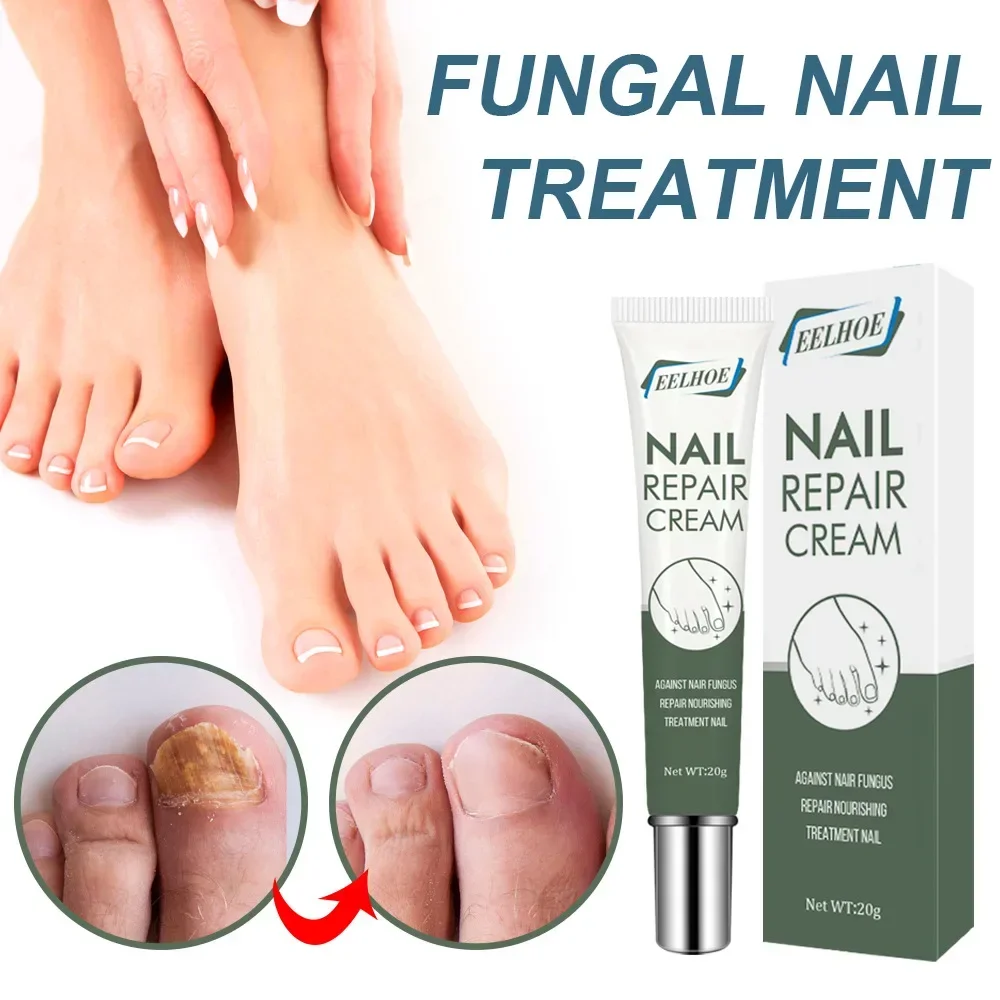 Repair Cream Rapid Removal of Grey Nail Repair Nail Care Ointment Thickening Soft Nail Cream Gel Foot Care Callus Remover