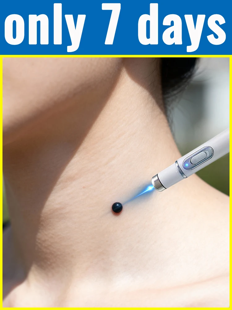 2. generacja ulepszona technologii usuwania brodawek bez bólu, szybkie usuwanie brodawek z korzeniem.