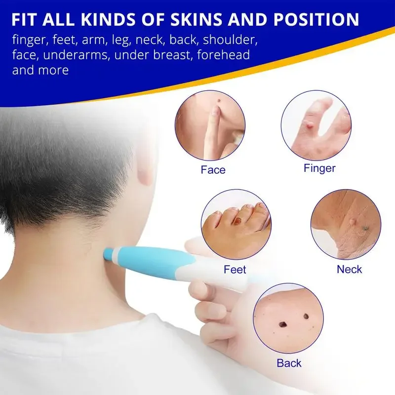 Double Headed Wart Removing Pen Set Auto Skin Tag Remover Painless Mole Wart Remover Skin Tag Removal Kit Skin Care Beauty Tool image 5