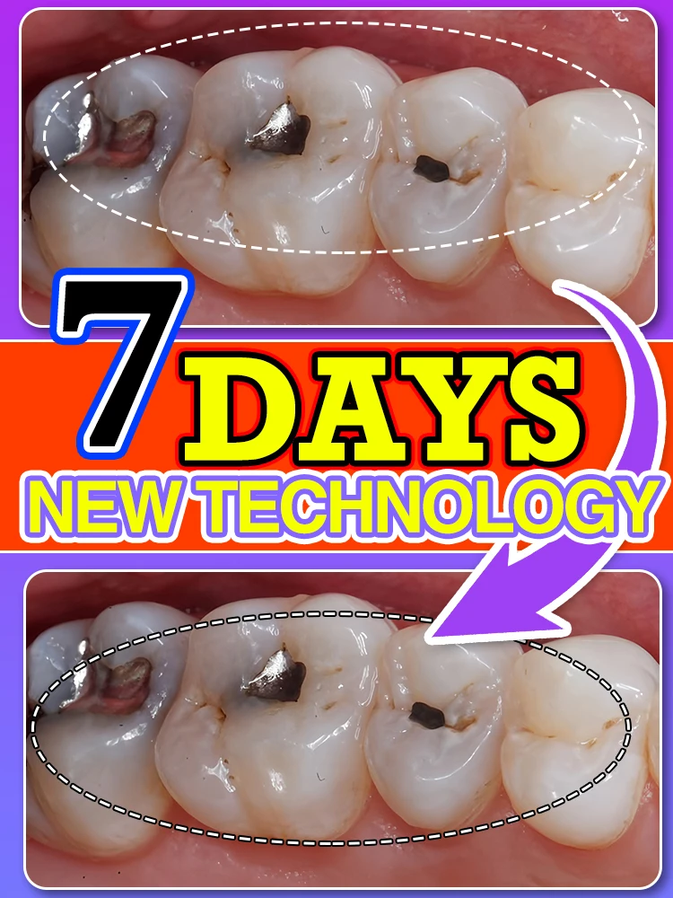 

decay Tooth Repair Repairing Cavities Protect Anti caries Permanent Say goodbye to toothache