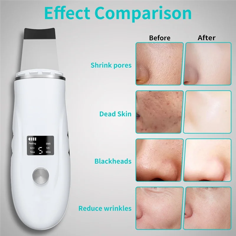 Snel oplaadstation Skin Scrubber Gezichtsspatel-diepe reinigingshulpmiddel voor porienextractie, mee-eterverwijderaar