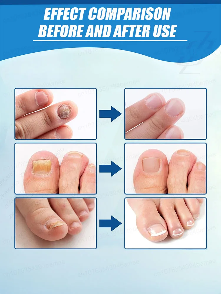 Prevent onychomycosis from getting worse and ᵖʳᵒᵗᵉᶜᵗ ᵗʰᵉ ʰᵉᵃˡᵗʰʸ ᵉⁿᵛⁱʳᵒⁿᵐᵉⁿᵗ ᵒᶠ ᵗʰᵉ ᶠᵉᵉᵗ