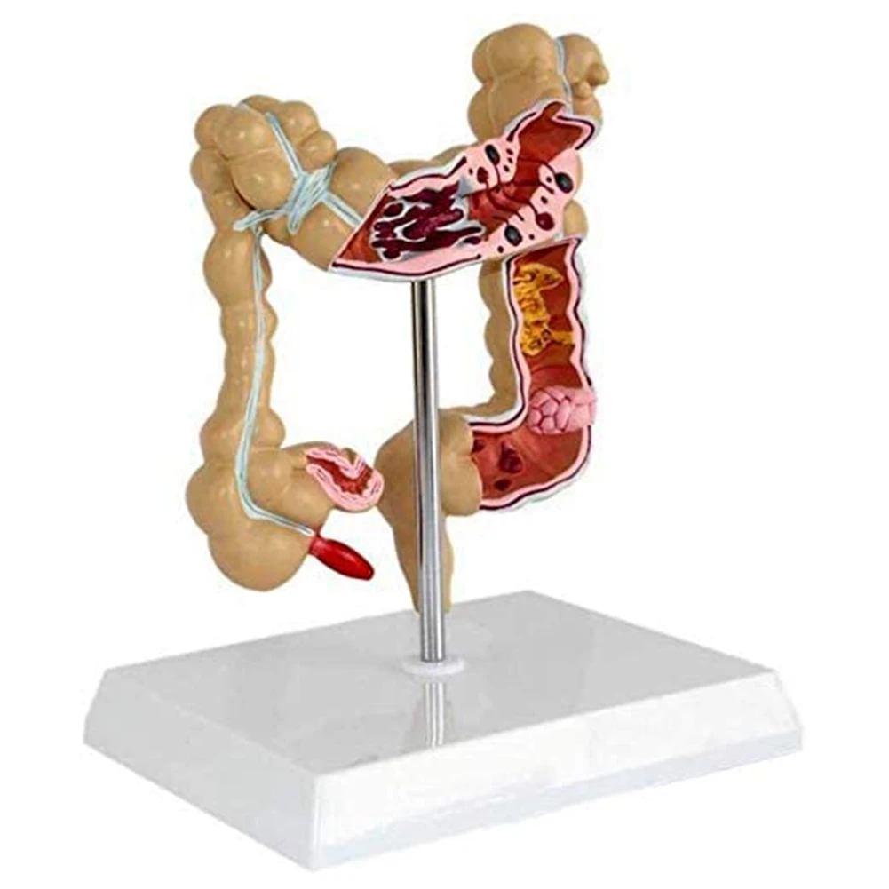 Modelo de cáncer coloreatural patológico del colon Modelo de intestino grueso Modelo anatómico gastrointestinal