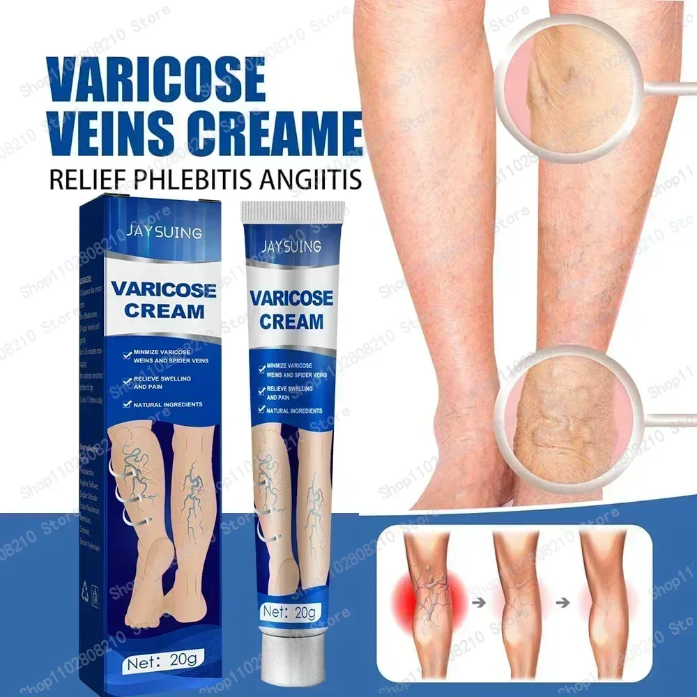 HOT SALE Varicose Veins Varicosity Leg Phlebitis Vasculitis Treatment Swelling Pain Relief Spider Removal Plaster Care